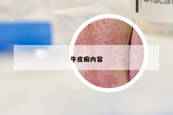 牛皮癣内容
