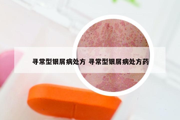 寻常型银屑病处方 寻常型银屑病处方药