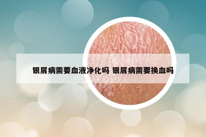 银屑病需要血液净化吗 银屑病需要换血吗