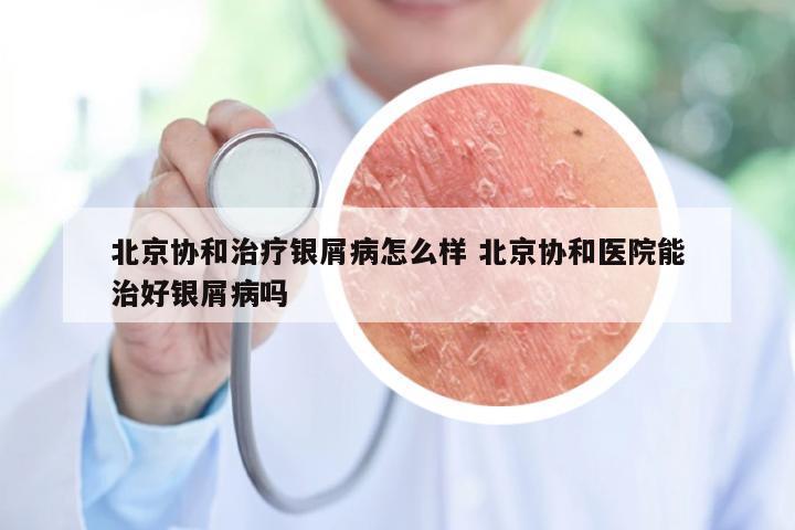 北京协和治疗银屑病怎么样 北京协和医院能治好银屑病吗