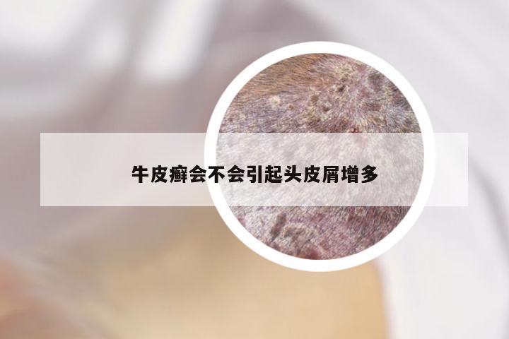 牛皮癣会不会引起头皮屑增多