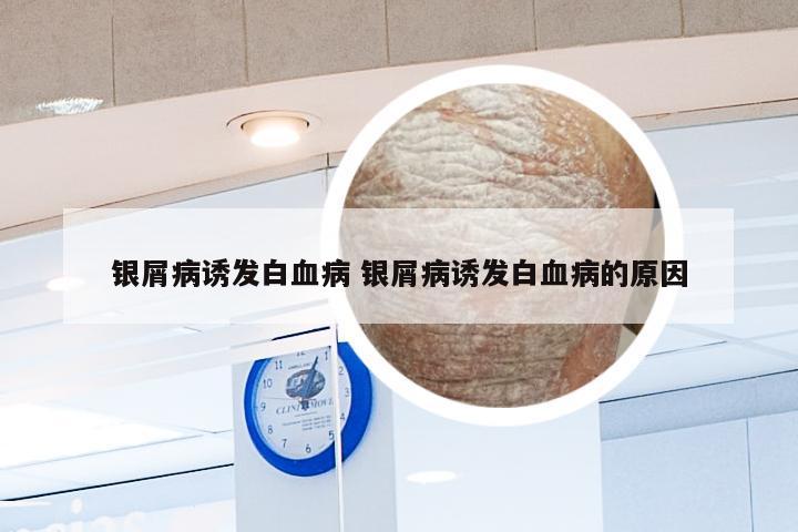 银屑病诱发白血病 银屑病诱发白血病的原因