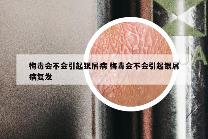梅毒会不会引起银屑病 梅毒会不会引起银屑病复发