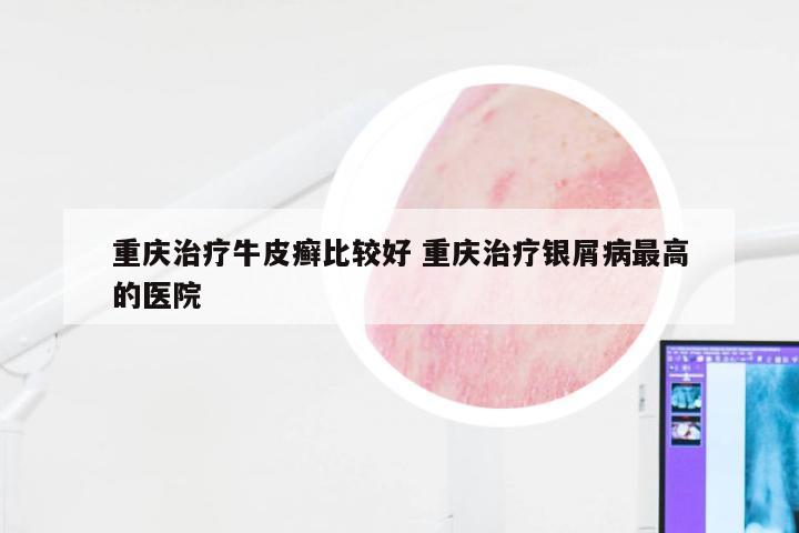 重庆治疗牛皮癣比较好 重庆治疗银屑病最高的医院
