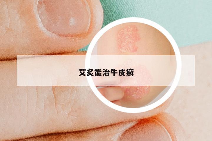 艾炙能治牛皮癣