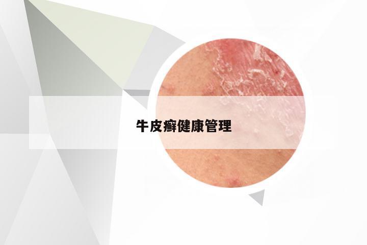 牛皮癣健康管理