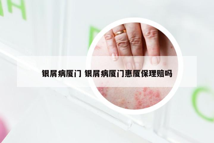 银屑病厦门 银屑病厦门惠厦保理赔吗