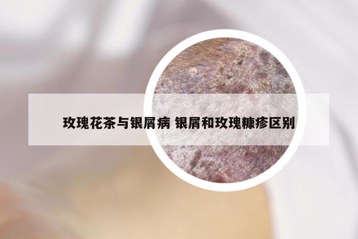 玫瑰花茶与银屑病 银屑和玫瑰糠疹区别