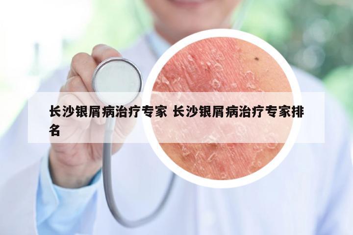 长沙银屑病治疗专家 长沙银屑病治疗专家排名