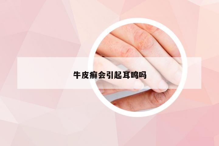 牛皮癣会引起耳鸣吗
