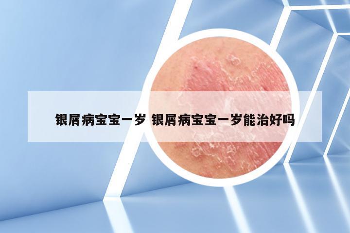 银屑病宝宝一岁 银屑病宝宝一岁能治好吗
