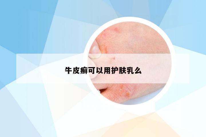牛皮癣可以用护肤乳么