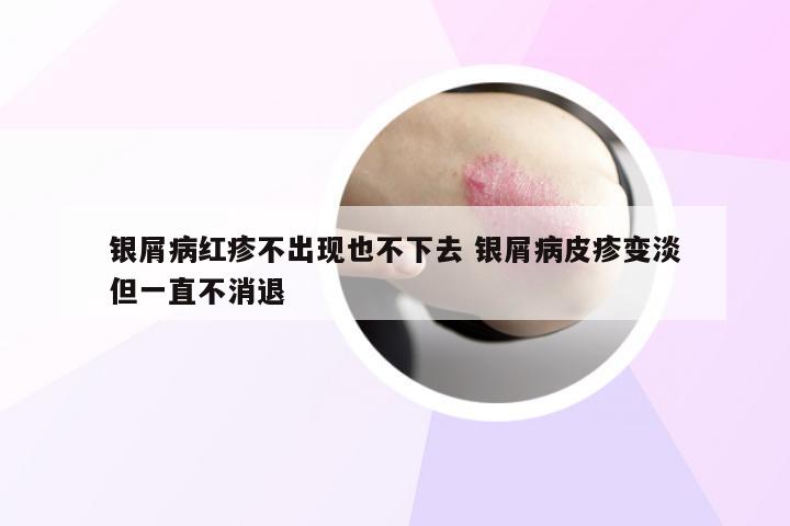 银屑病红疹不出现也不下去 银屑病皮疹变淡但一直不消退