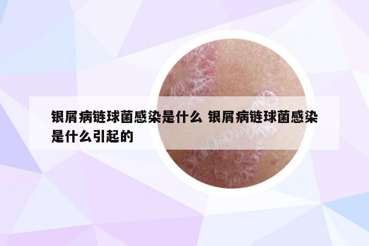 银屑病链球菌感染是什么 银屑病链球菌感染是什么引起的