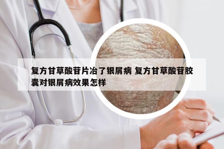 复方甘草酸苷片冶了银屑病 复方甘草酸苷胶囊对银屑病效果怎样