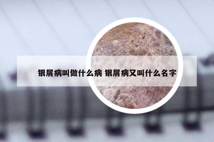 银屑病叫做什么病 银屑病又叫什么名字