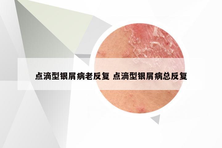 点滴型银屑病老反复 点滴型银屑病总反复