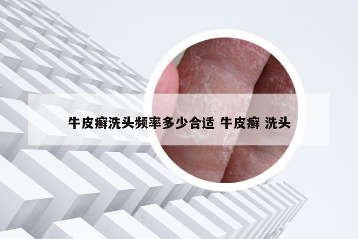 牛皮癣洗头频率多少合适 牛皮癣 洗头