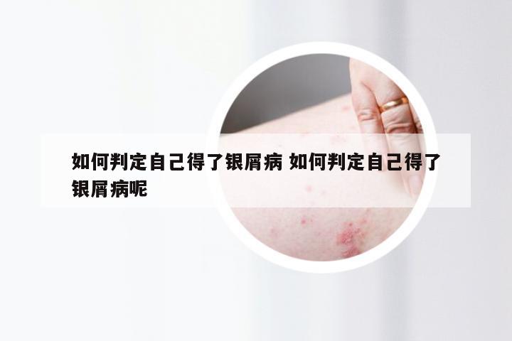 如何判定自己得了银屑病 如何判定自己得了银屑病呢