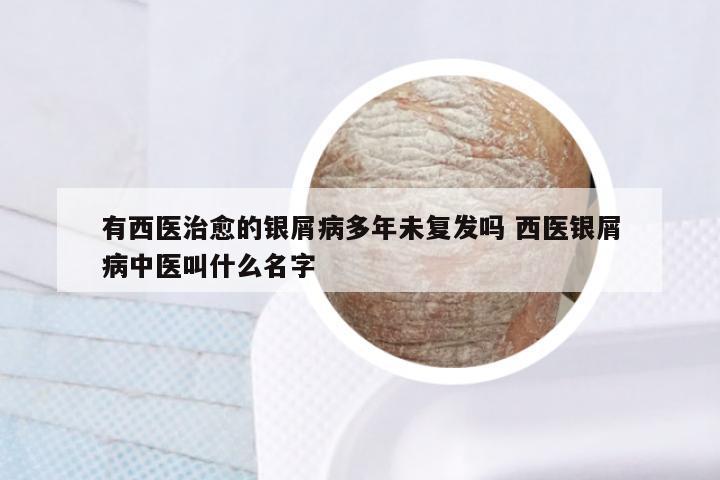 有西医治愈的银屑病多年未复发吗 西医银屑病中医叫什么名字