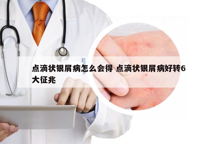 点滴状银屑病怎么会得 点滴状银屑病好转6大征兆