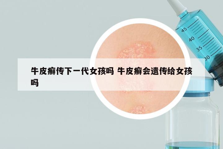 牛皮癣传下一代女孩吗 牛皮癣会遗传给女孩吗