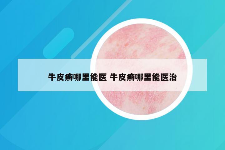 牛皮癣哪里能医 牛皮癣哪里能医治