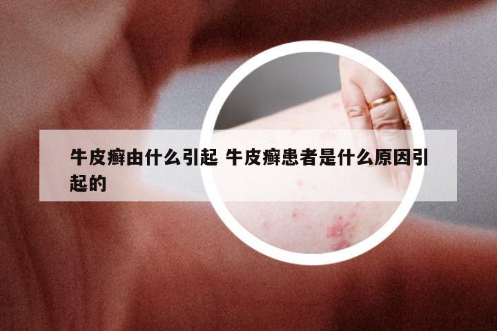 牛皮癣由什么引起 牛皮癣患者是什么原因引起的