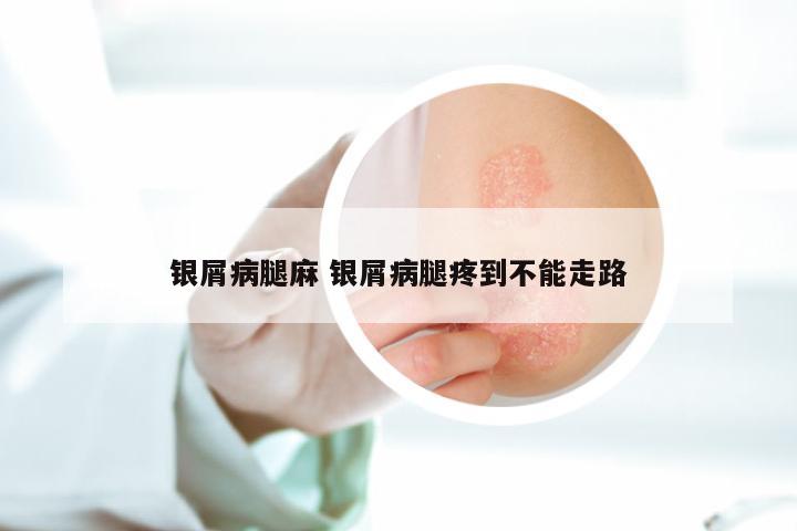 银屑病腿麻 银屑病腿疼到不能走路