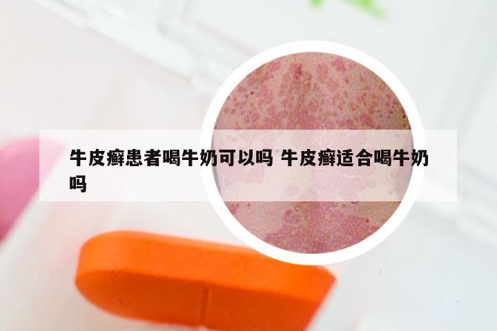 牛皮癣患者喝牛奶可以吗 牛皮癣适合喝牛奶吗