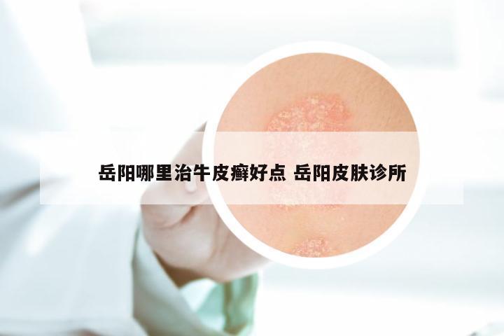 岳阳哪里治牛皮癣好点 岳阳皮肤诊所