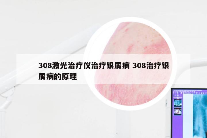 308激光治疗仪治疗银屑病 308治疗银屑病的原理
