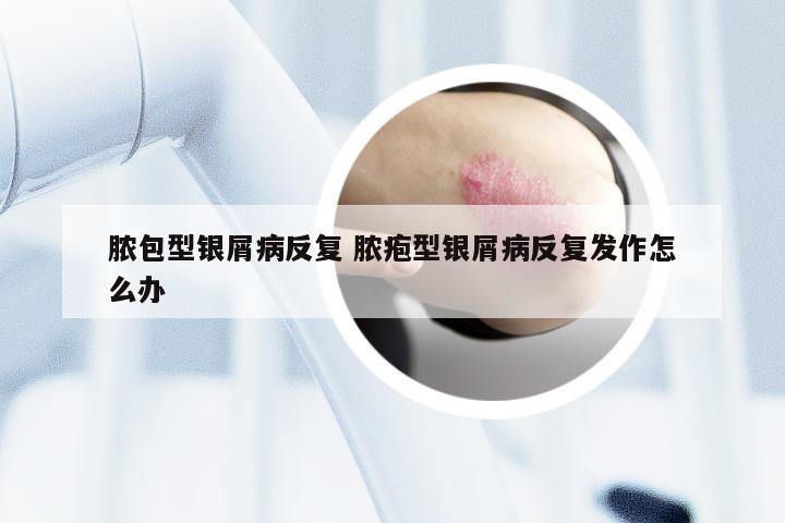 脓包型银屑病反复 脓疱型银屑病反复发作怎么办