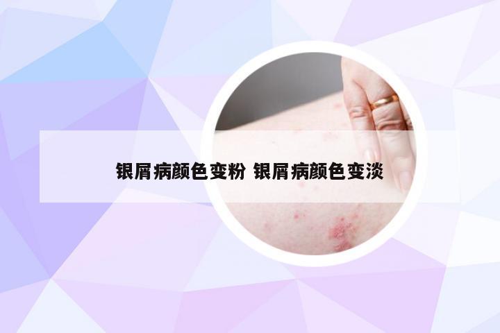 银屑病颜色变粉 银屑病颜色变淡