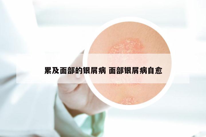 累及面部的银屑病 面部银屑病自愈
