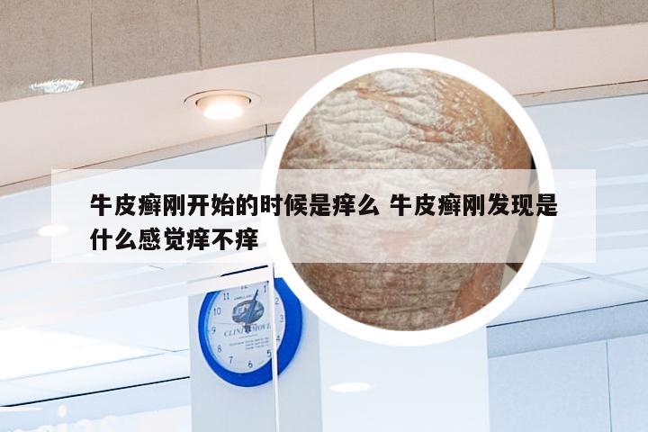 牛皮癣刚开始的时候是痒么 牛皮癣刚发现是什么感觉痒不痒