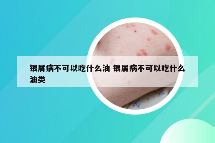 银屑病不可以吃什么油 银屑病不可以吃什么油类