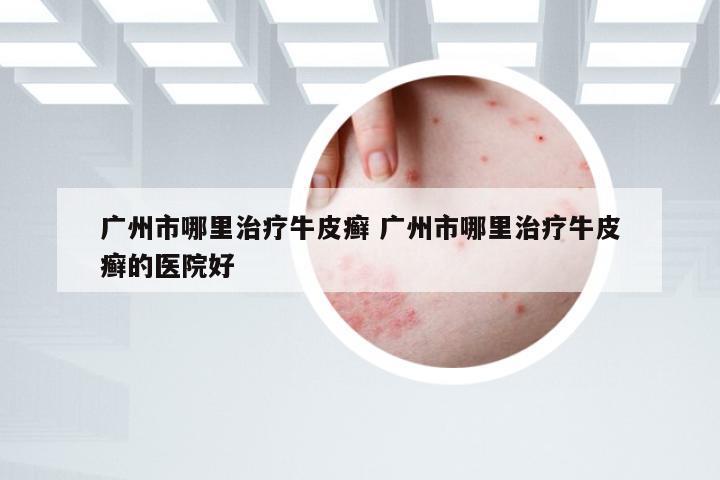 广州市哪里治疗牛皮癣 广州市哪里治疗牛皮癣的医院好