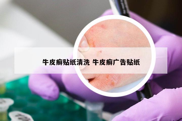 牛皮癣贴纸清洗 牛皮癣广告贴纸