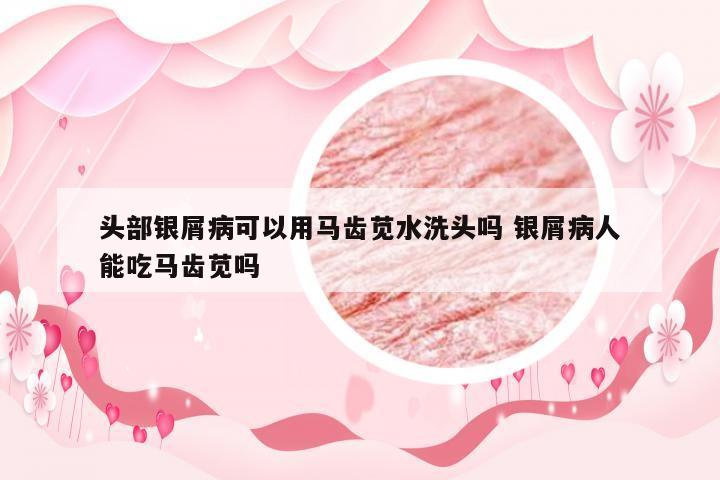 头部银屑病可以用马齿苋水洗头吗 银屑病人能吃马齿苋吗