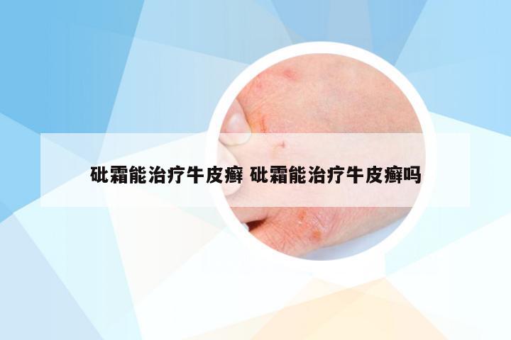 砒霜能治疗牛皮癣 砒霜能治疗牛皮癣吗
