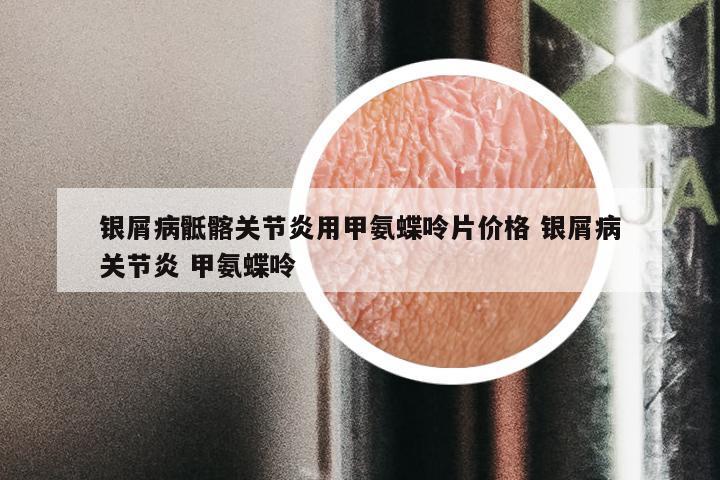 银屑病骶髂关节炎用甲氨蝶呤片价格 银屑病关节炎 甲氨蝶呤