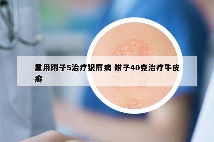 重用附子5治疗银屑病 附子40克治疗牛皮癣