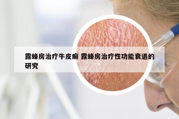 露蜂房治疗牛皮癣 露蜂房治疗性功能衰退的研究