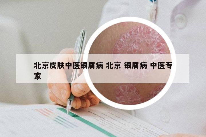 北京皮肤中医银屑病 北京 银屑病 中医专家