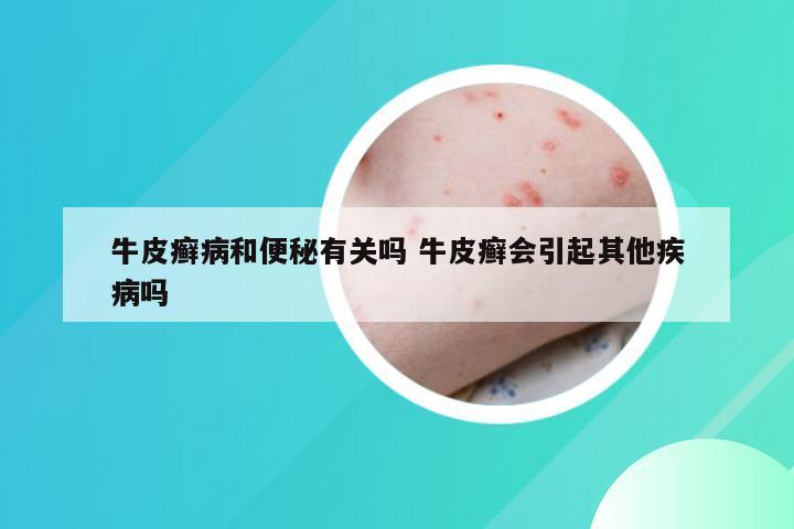 牛皮癣病和便秘有关吗 牛皮癣会引起其他疾病吗