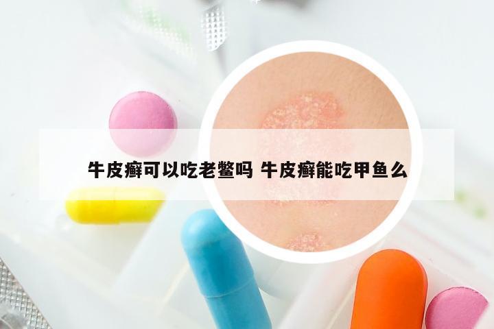 牛皮癣可以吃老鳖吗 牛皮癣能吃甲鱼么