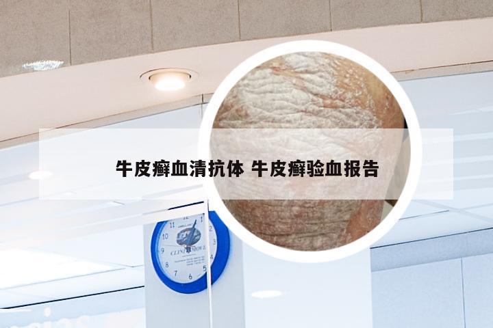 牛皮癣血清抗体 牛皮癣验血报告