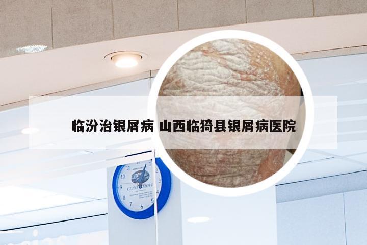 临汾治银屑病 山西临猗县银屑病医院