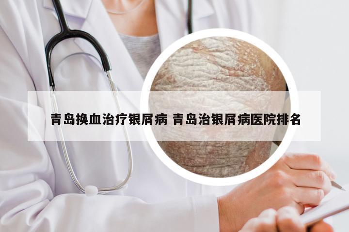 青岛换血治疗银屑病 青岛治银屑病医院排名